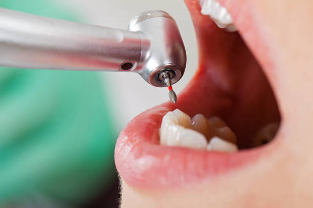 Best Emergency Tooth Extraction in St Cloud, MN